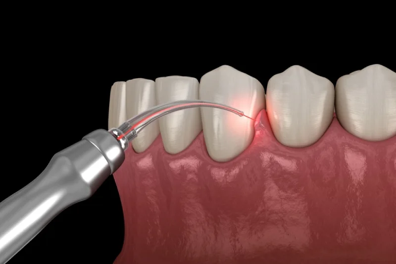Dentist in Kingsburg CA, Dental Implants and Cosmetic Dentistry 93631|Soft Tissue Periodontics