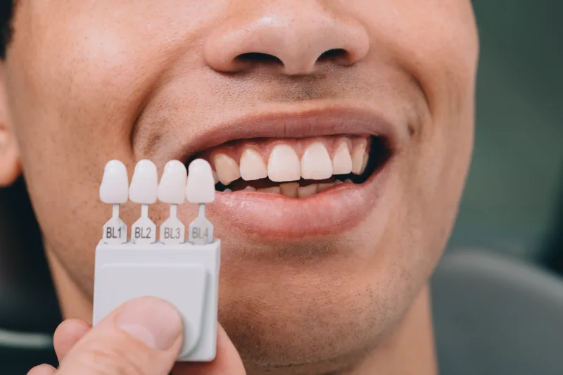 Dentist in Kingsburg CA, Dental Implants and Cosmetic Dentistry 93631|Veneers