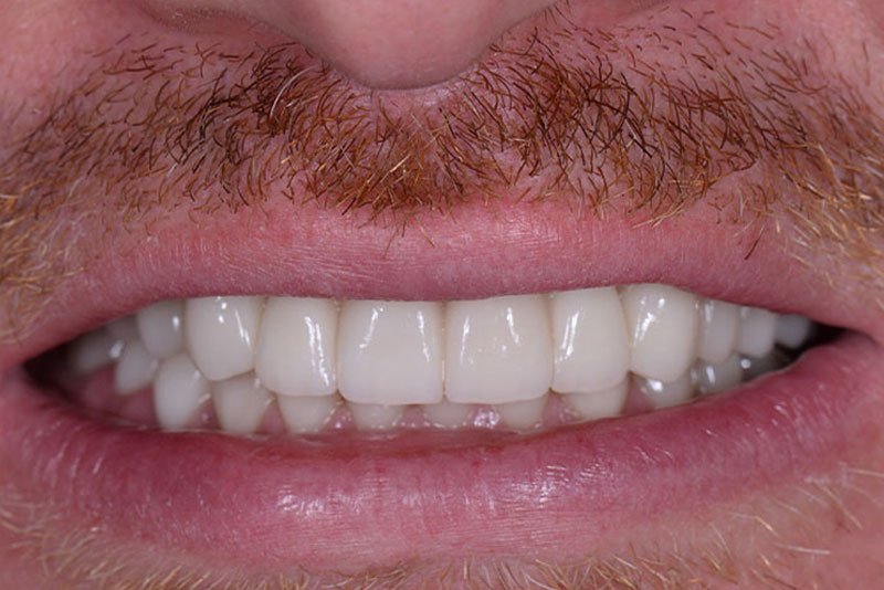 Dentist in Kingsburg CA, Dental Implants and Cosmetic Dentistry 93631 | Before & After Photos