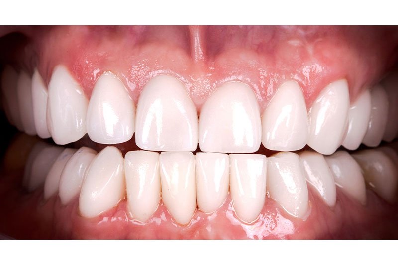 Dentist in Kingsburg CA, Dental Implants and Cosmetic Dentistry 93631 | Before & After Photos