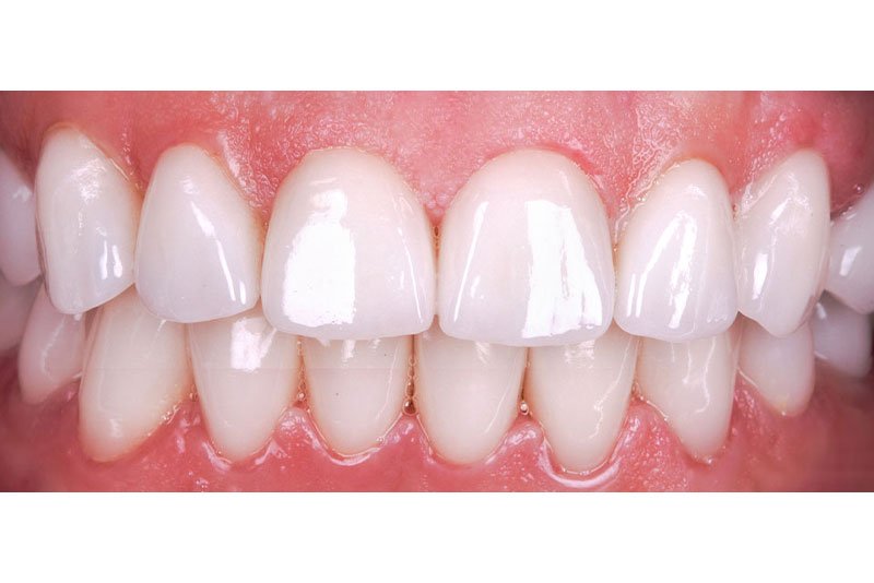 Dentist in Kingsburg CA, Dental Implants and Cosmetic Dentistry 93631 | Before & After Photos