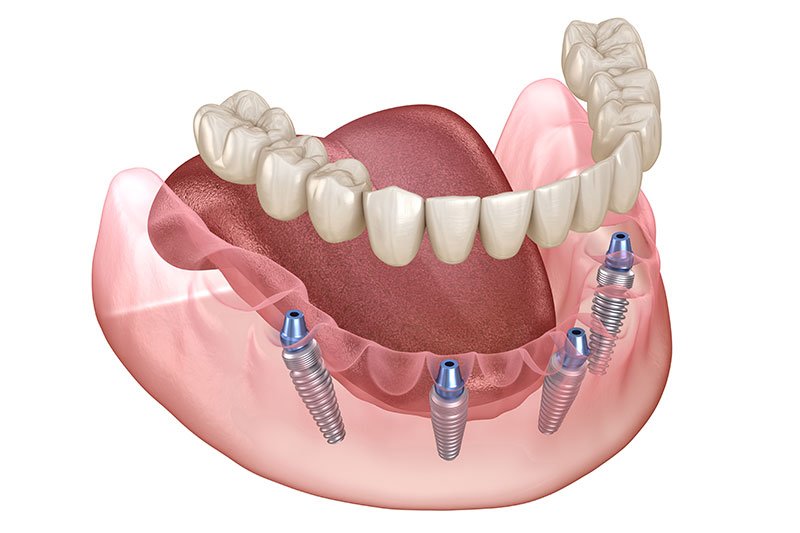 Dentist in Kingsburg CA, Dental Implants and Cosmetic Dentistry 93631|All on X Dental Implants