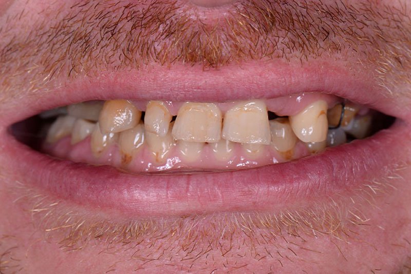 Dentist in Kingsburg CA, Dental Implants and Cosmetic Dentistry 93631 | Before & After Photos