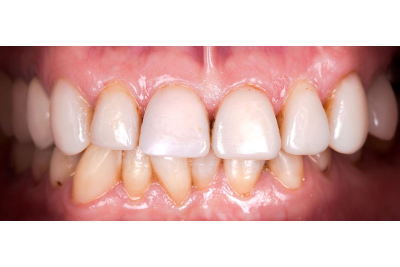 Dentist in Kingsburg CA, Dental Implants and Cosmetic Dentistry 93631 | Before & After Photos