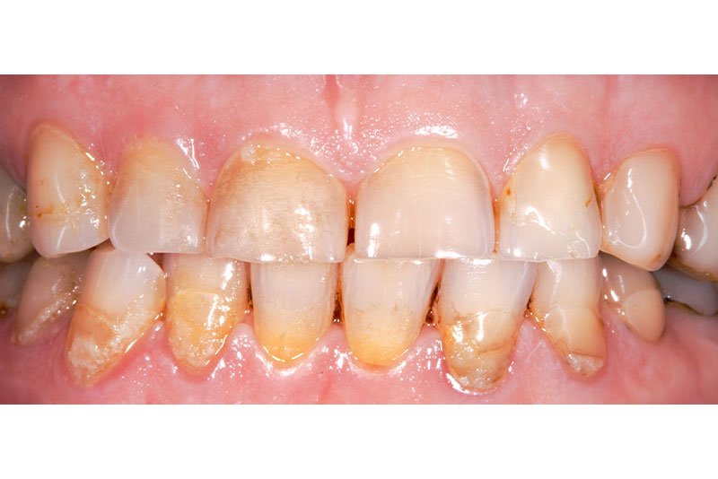Dentist in Kingsburg CA, Dental Implants and Cosmetic Dentistry 93631 | Before & After Photos
