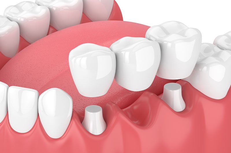 Dentist in Kingsburg CA, Dental Implants and Cosmetic Dentistry 93631|Zirconia Fixed Dental Bridges