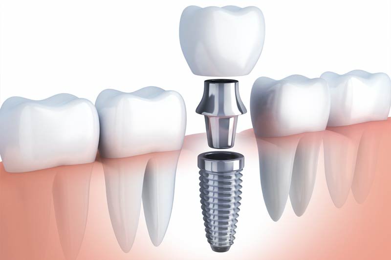 Dentist in Kingsburg CA, Dental Implants and Cosmetic Dentistry 93631|Dental Implants