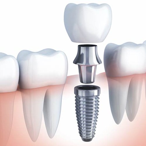dental-implants_1