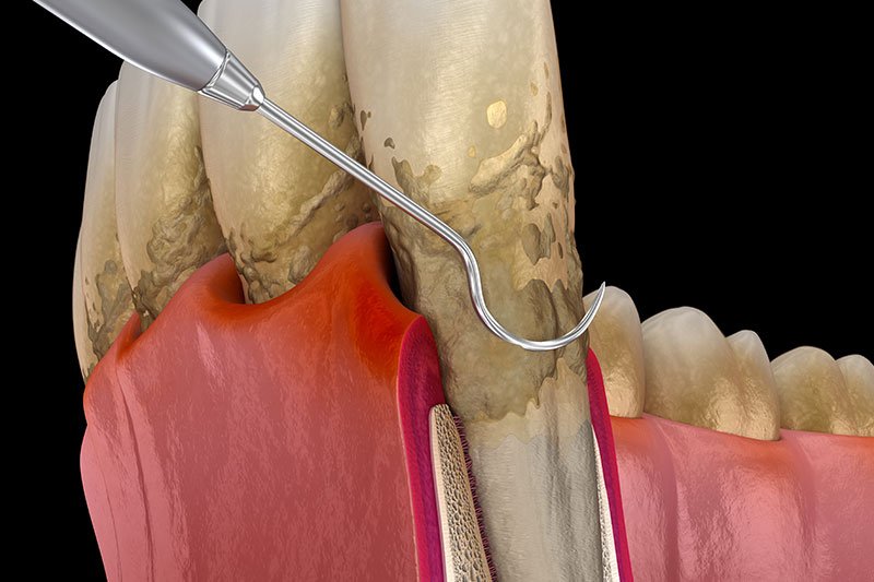 Dentist in Kingsburg CA, Dental Implants and Cosmetic Dentistry 93631|Periodontal Treatments