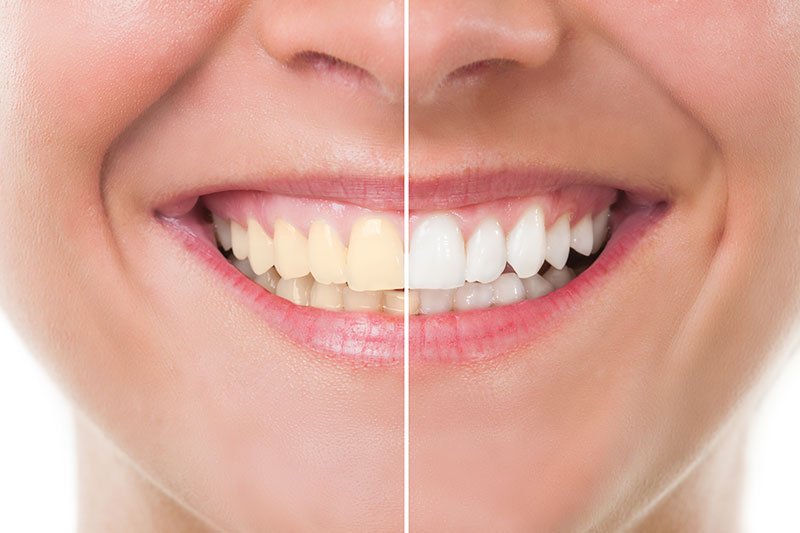 Dentist in Kingsburg CA, Dental Implants and Cosmetic Dentistry 93631|Teeth Whitening / Cleaning
