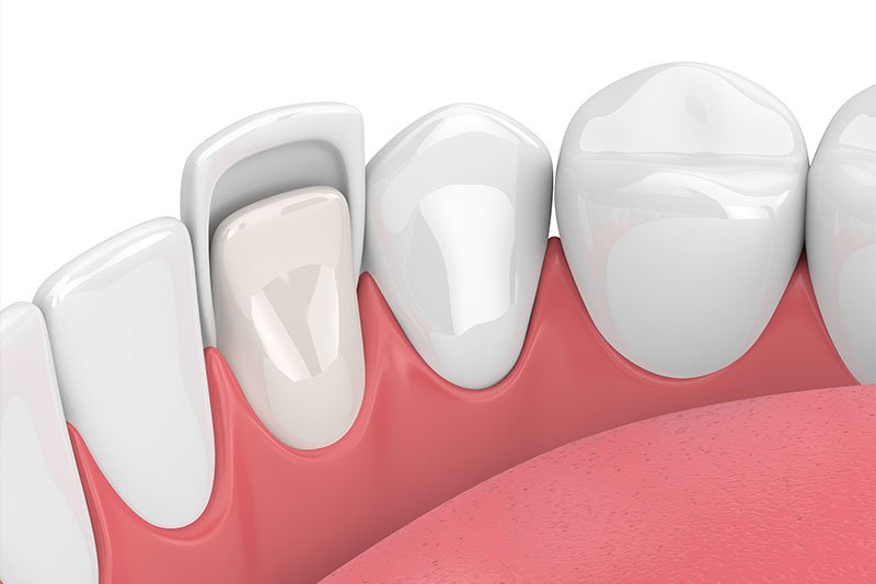 Dentist in Kingsburg CA, Dental Implants and Cosmetic Dentistry 93631|Lumineers